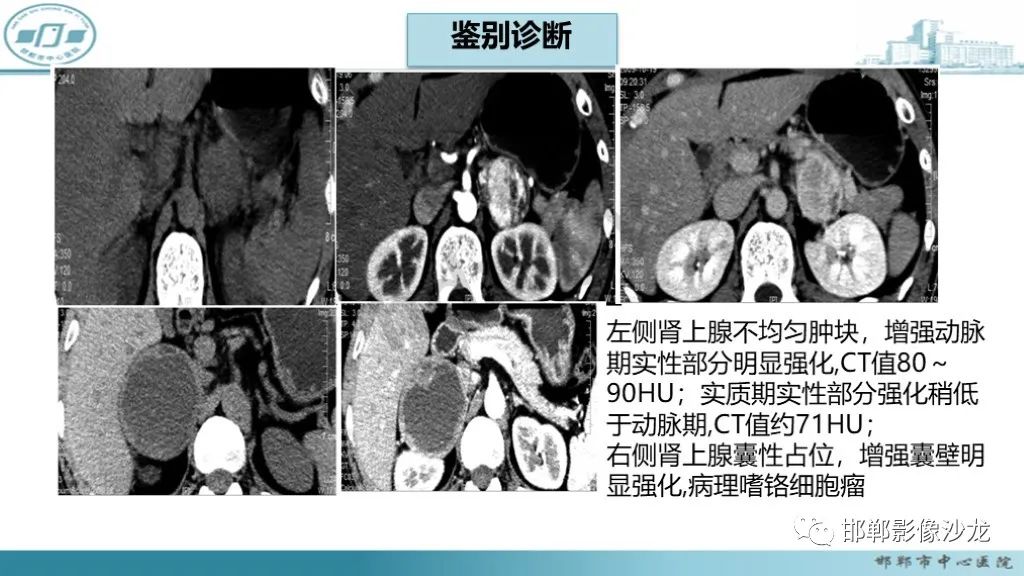 影像PPT - 【PPT】肾上腺结核-43