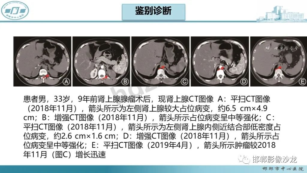 影像PPT - 【PPT】肾上腺结核-45