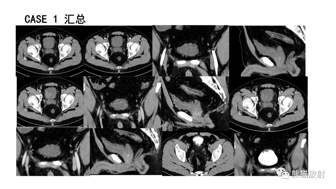 影像PPT - 【病例】腺性膀胱炎 VS 膀胱癌-4