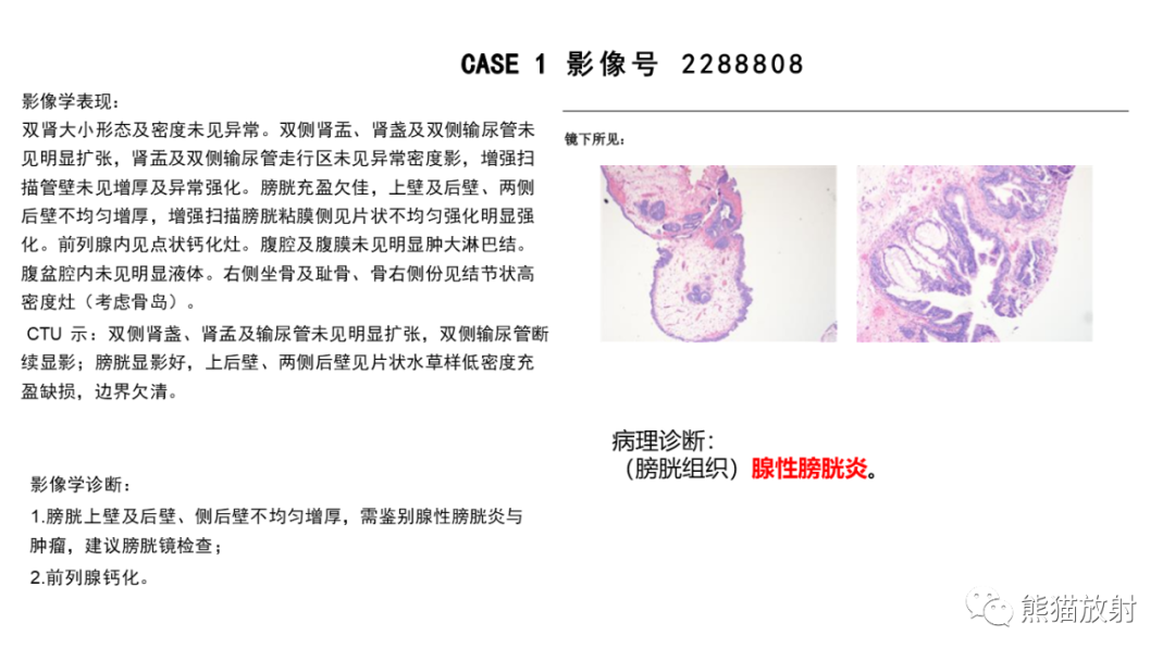 影像PPT - 【病例】腺性膀胱炎 VS 膀胱癌-9