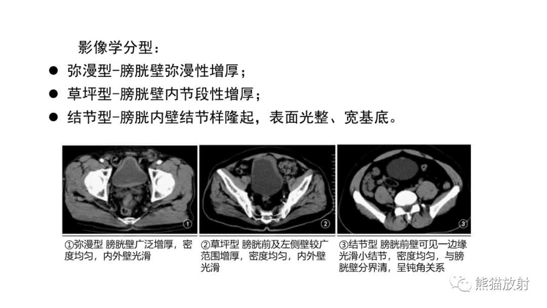 影像PPT - 【病例】腺性膀胱炎 VS 膀胱癌-17