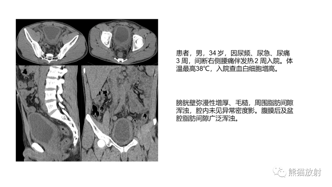 影像PPT - 【病例】腺性膀胱炎 VS 膀胱癌-18
