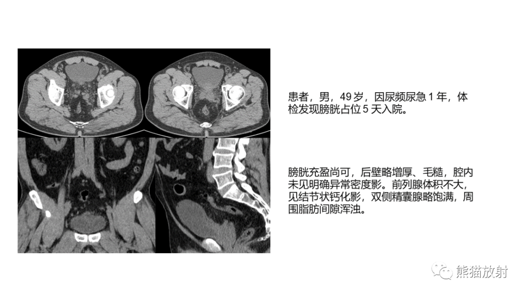 影像PPT - 【病例】腺性膀胱炎 VS 膀胱癌-19