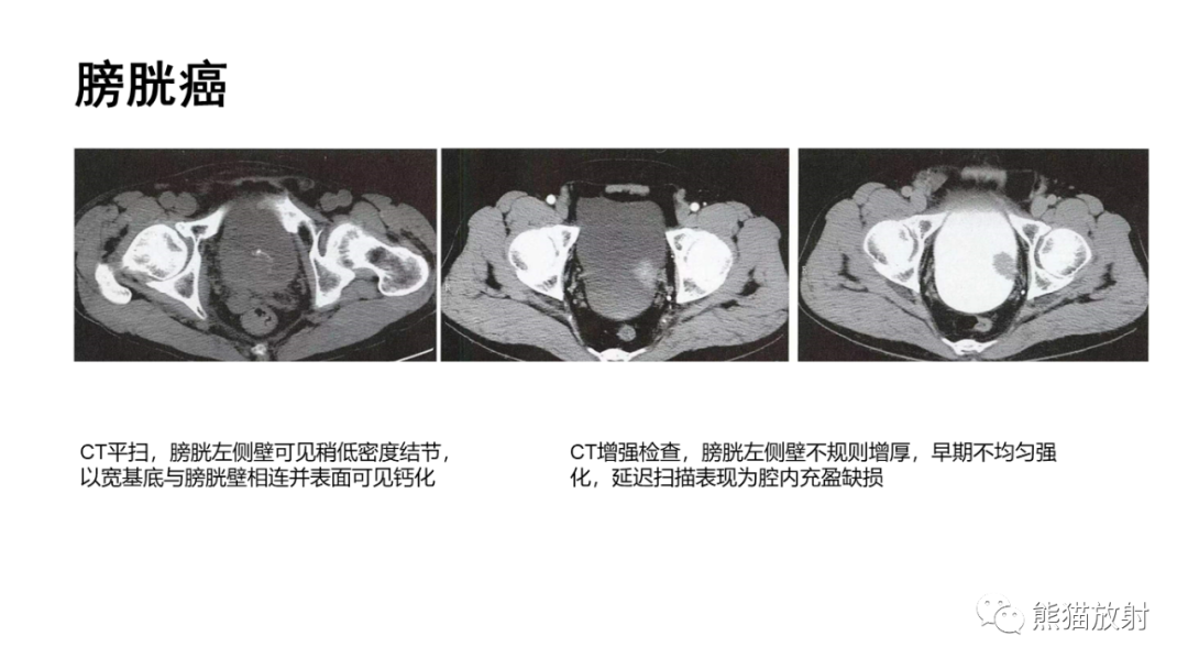 影像PPT - 【病例】腺性膀胱炎 VS 膀胱癌-23