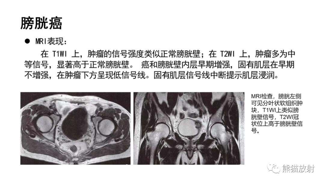 影像PPT - 【病例】腺性膀胱炎 VS 膀胱癌-24