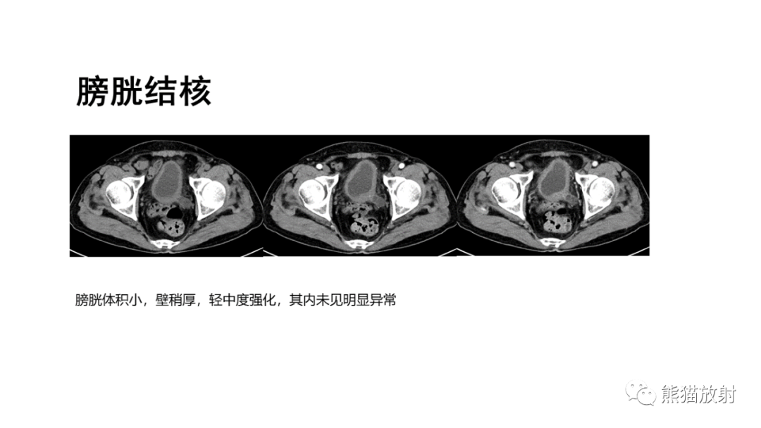 影像PPT - 【病例】腺性膀胱炎 VS 膀胱癌-28