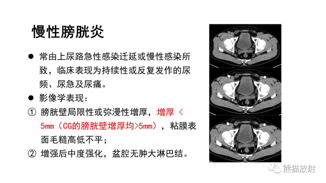 影像PPT - 【病例】腺性膀胱炎 VS 膀胱癌-30