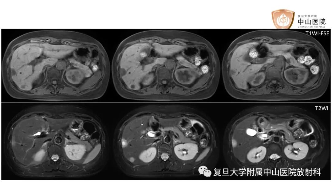 影像PPT - 【病例】肝脏上皮样血管内皮瘤1例MR影像-4