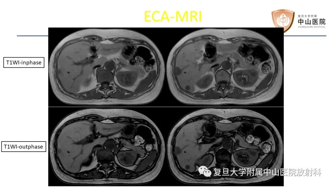 影像PPT - 【病例】肝脏上皮样血管内皮瘤1例MR影像-3