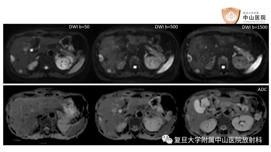 影像PPT - 【病例】肝脏上皮样血管内皮瘤1例MR影像-5