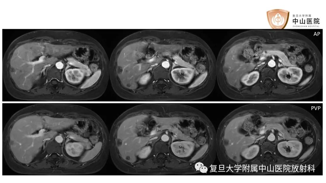 影像PPT - 【病例】肝脏上皮样血管内皮瘤1例MR影像-6