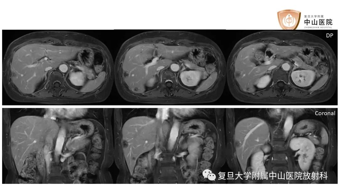 影像PPT - 【病例】肝脏上皮样血管内皮瘤1例MR影像-7
