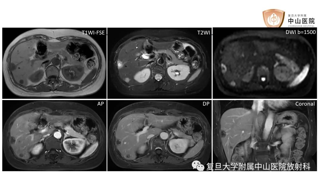 影像PPT - 【病例】肝脏上皮样血管内皮瘤1例MR影像-8