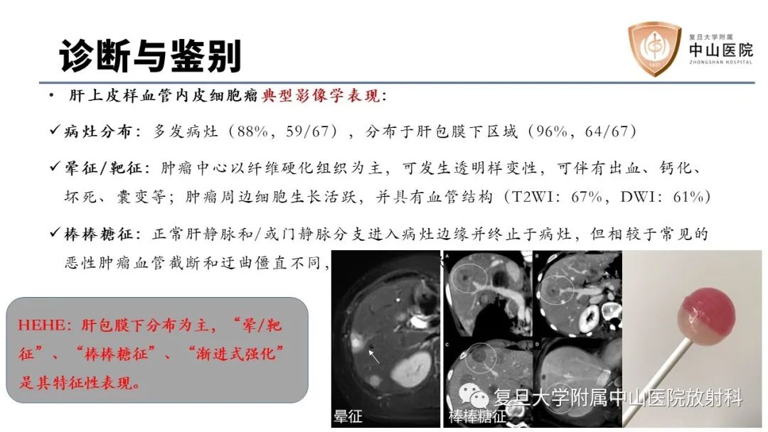 影像PPT - 【病例】肝脏上皮样血管内皮瘤1例MR影像-13
