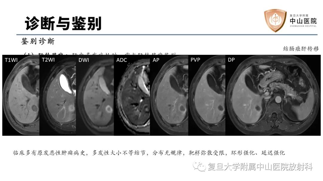 影像PPT - 【病例】肝脏上皮样血管内皮瘤1例MR影像-14