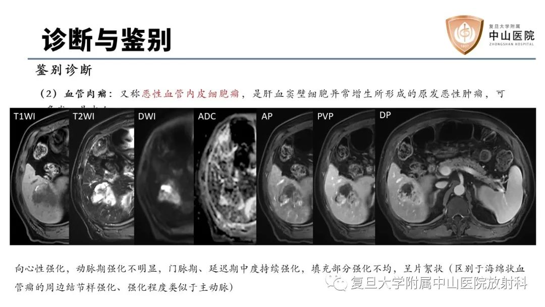 影像PPT - 【病例】肝脏上皮样血管内皮瘤1例MR影像-15