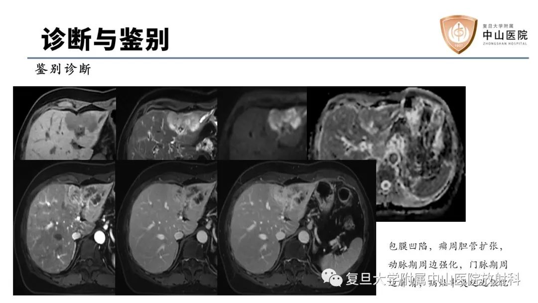 影像PPT - 【病例】肝脏上皮样血管内皮瘤1例MR影像-16