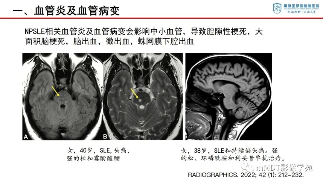 影像PPT - 【PPT】狼疮脑病的影像诊断-12