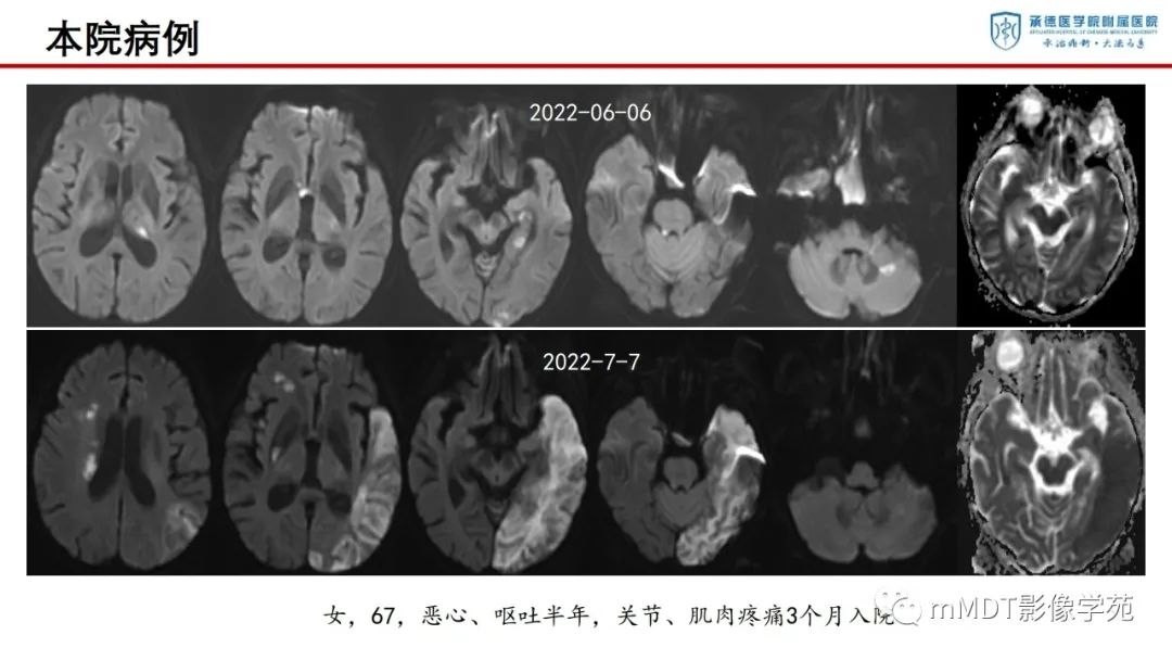 影像PPT - 【PPT】狼疮脑病的影像诊断-13