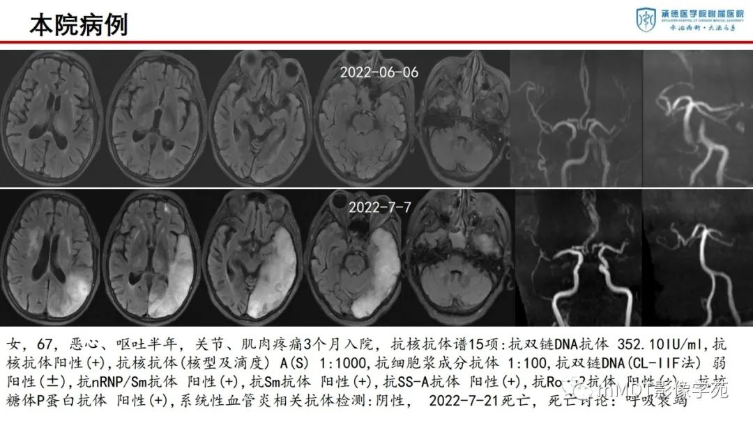 影像PPT - 【PPT】狼疮脑病的影像诊断-14