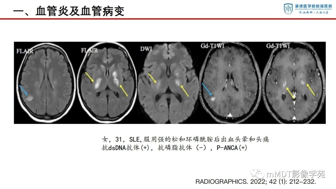 影像PPT - 【PPT】狼疮脑病的影像诊断-15