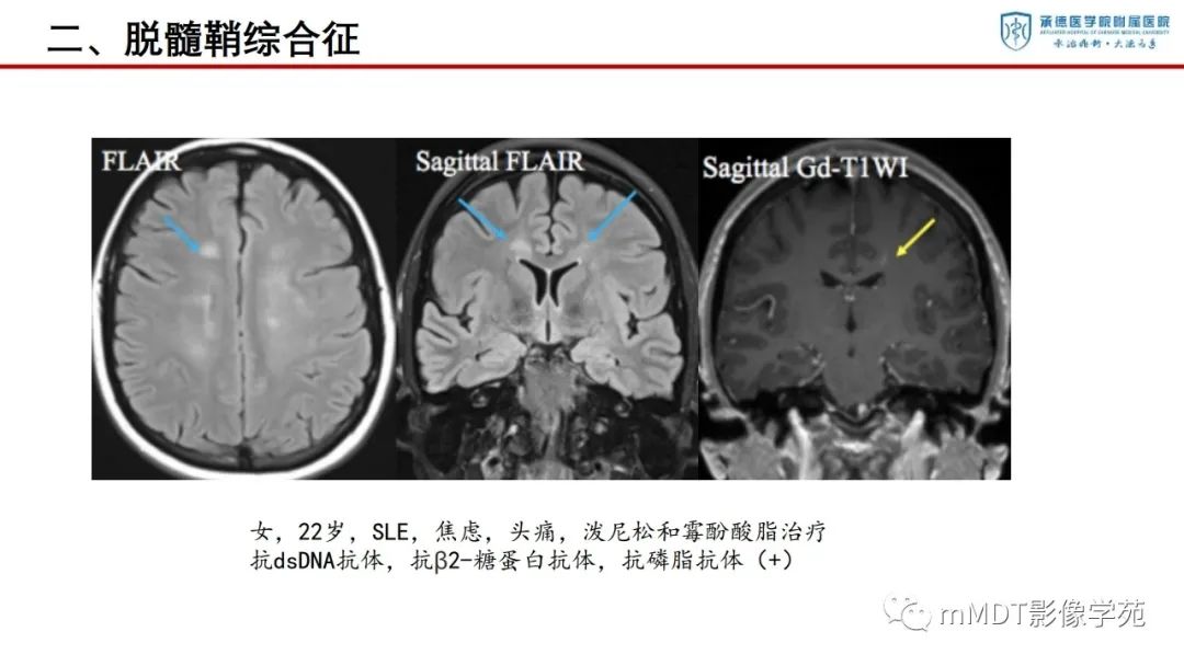 影像PPT - 【PPT】狼疮脑病的影像诊断-17