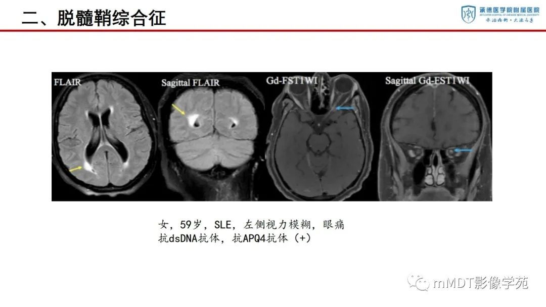 影像PPT - 【PPT】狼疮脑病的影像诊断-18