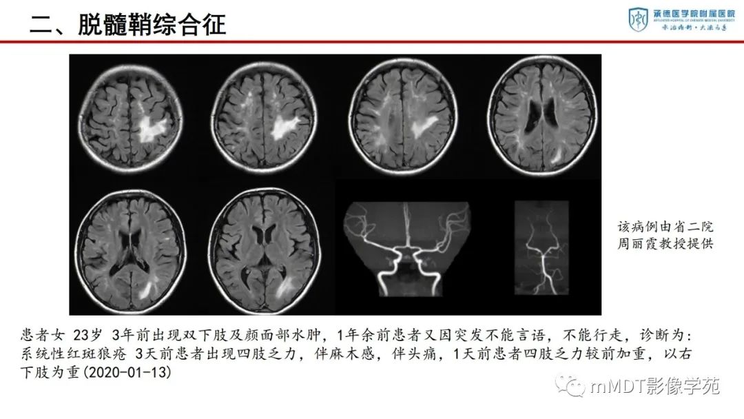 影像PPT - 【PPT】狼疮脑病的影像诊断-19