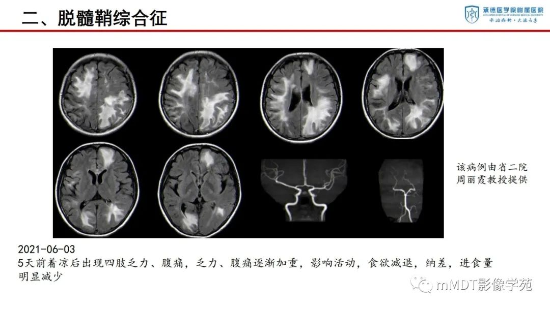 影像PPT - 【PPT】狼疮脑病的影像诊断-20