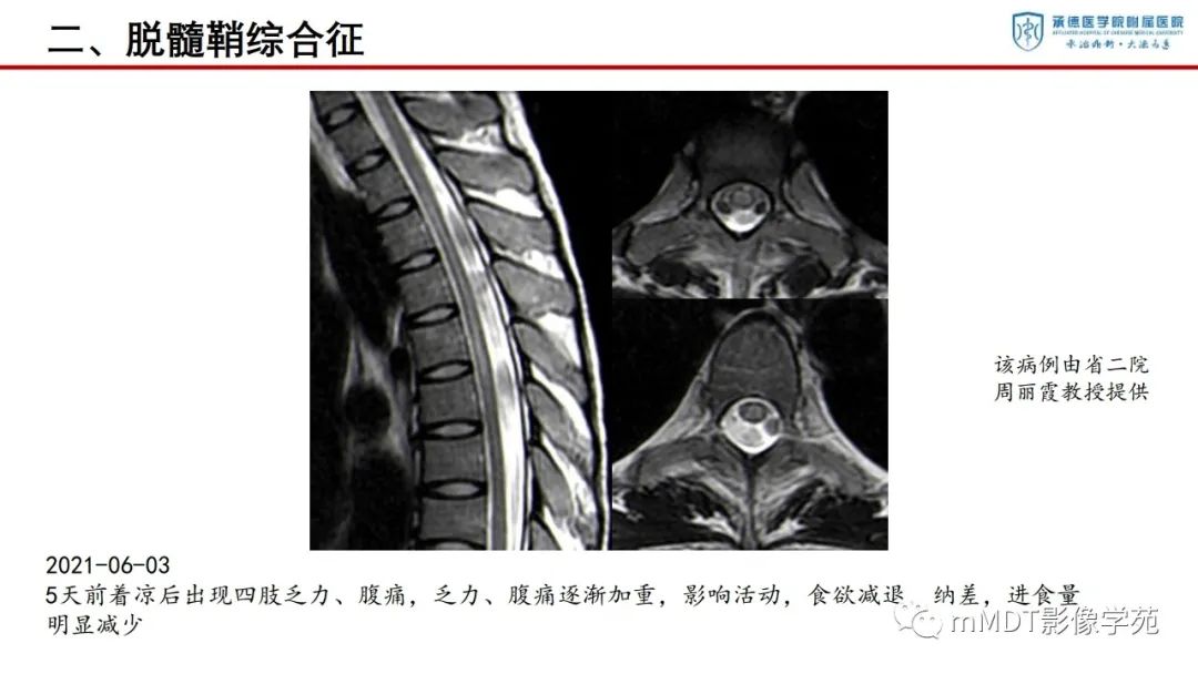 影像PPT - 【PPT】狼疮脑病的影像诊断-21