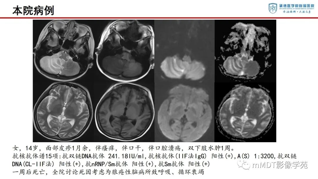 影像PPT - 【PPT】狼疮脑病的影像诊断-22