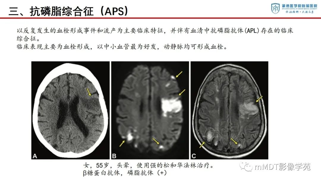影像PPT - 【PPT】狼疮脑病的影像诊断-23