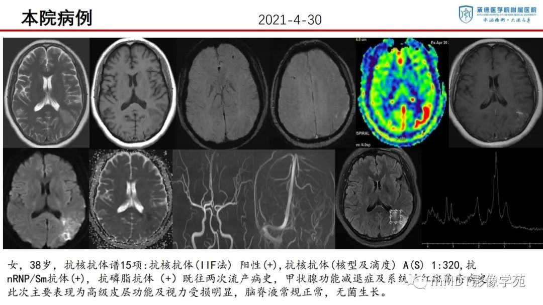影像PPT - 【PPT】狼疮脑病的影像诊断-24