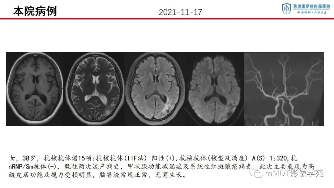 影像PPT - 【PPT】狼疮脑病的影像诊断-25