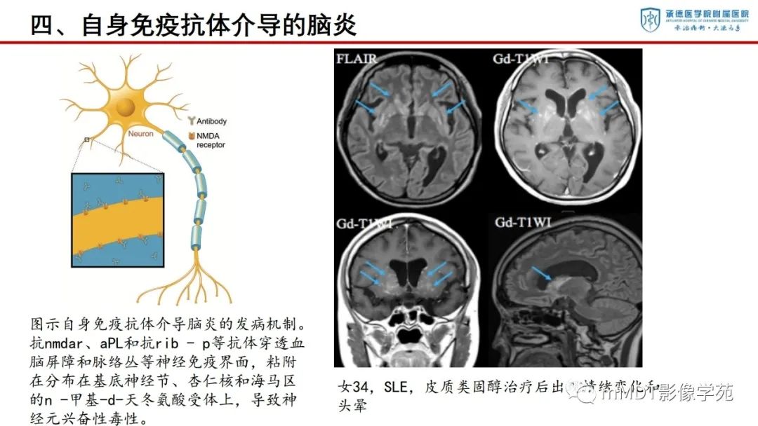 影像PPT - 【PPT】狼疮脑病的影像诊断-26