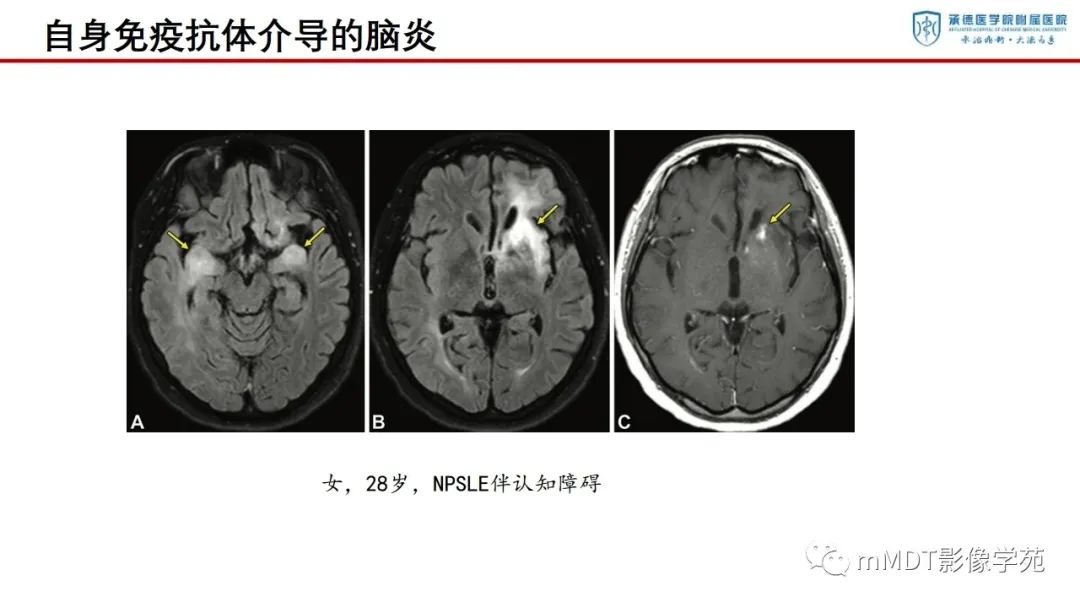 影像PPT - 【PPT】狼疮脑病的影像诊断-27