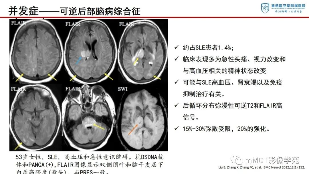 影像PPT - 【PPT】狼疮脑病的影像诊断-29
