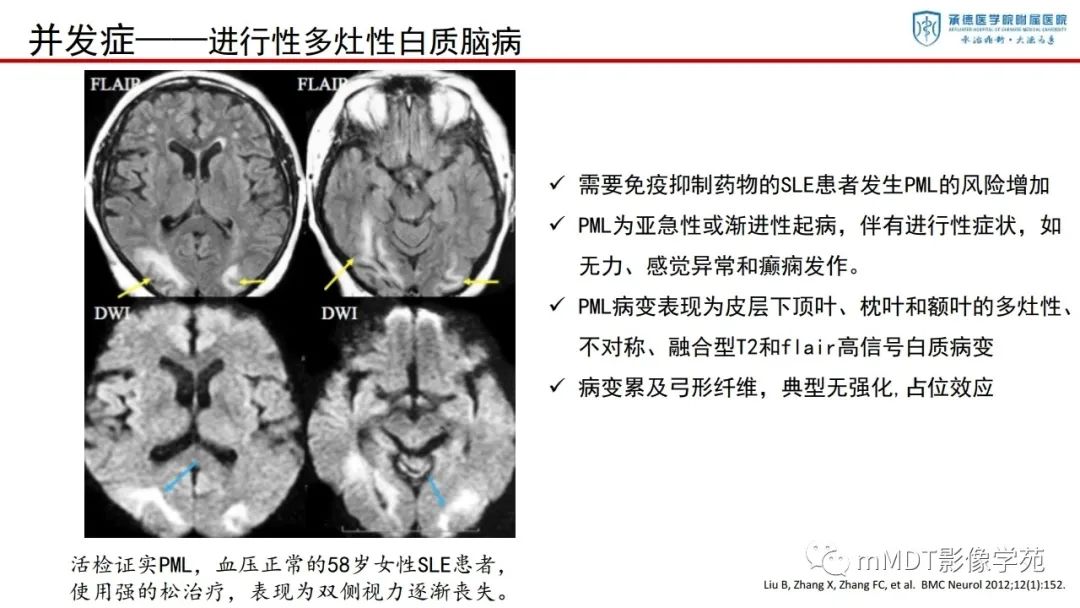 影像PPT - 【PPT】狼疮脑病的影像诊断-30