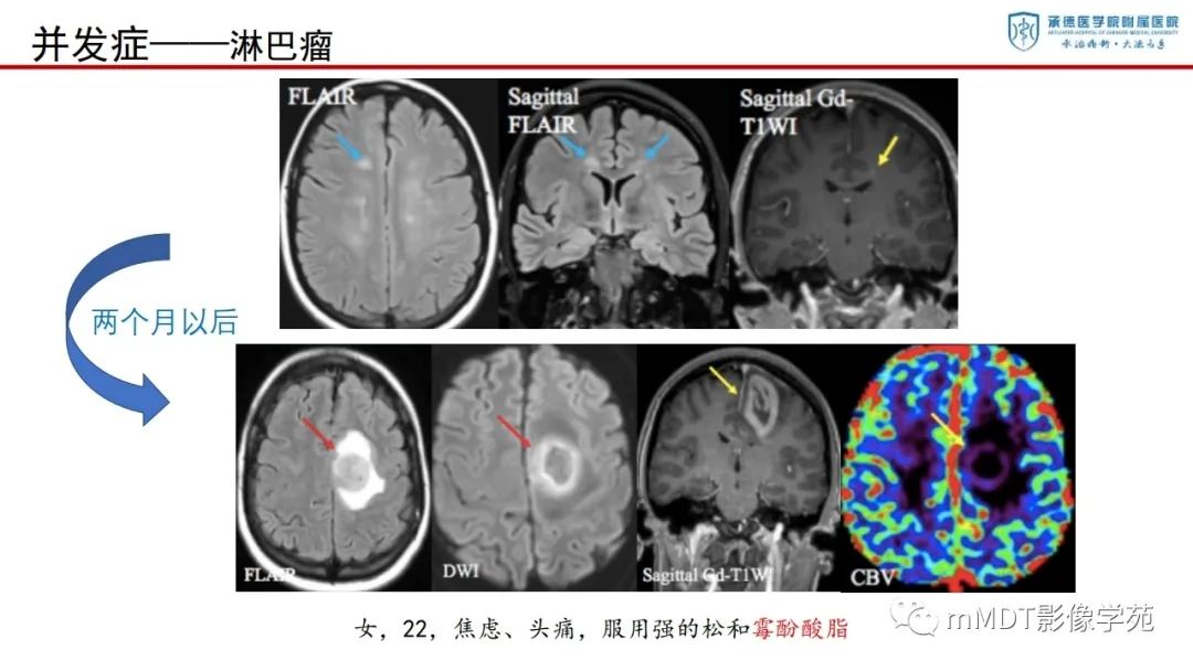 影像PPT - 【PPT】狼疮脑病的影像诊断-31
