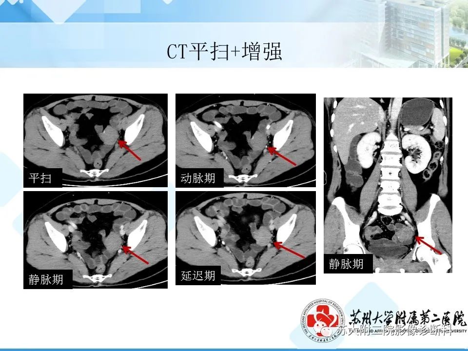 影像PPT - 【病例】卵巢Brenner瘤3例CT及MR影像-3
