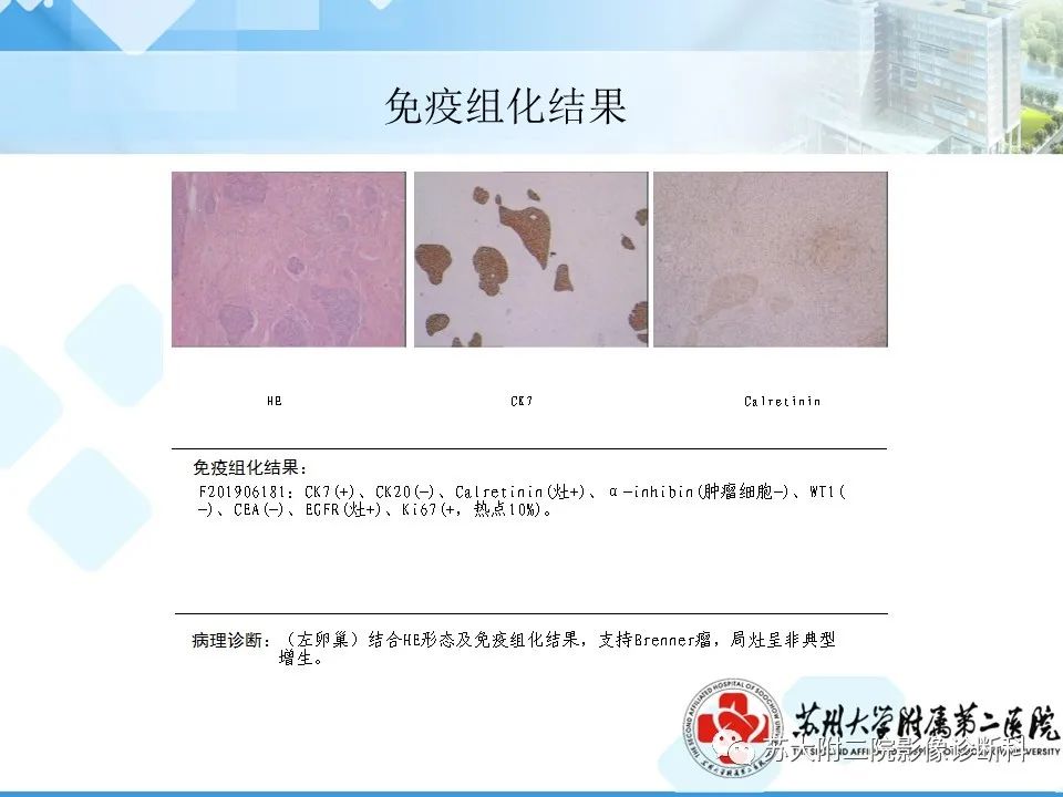 影像PPT - 【病例】卵巢Brenner瘤3例CT及MR影像-5