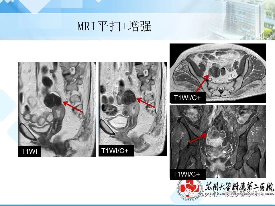 影像PPT - 【病例】卵巢Brenner瘤3例CT及MR影像-10