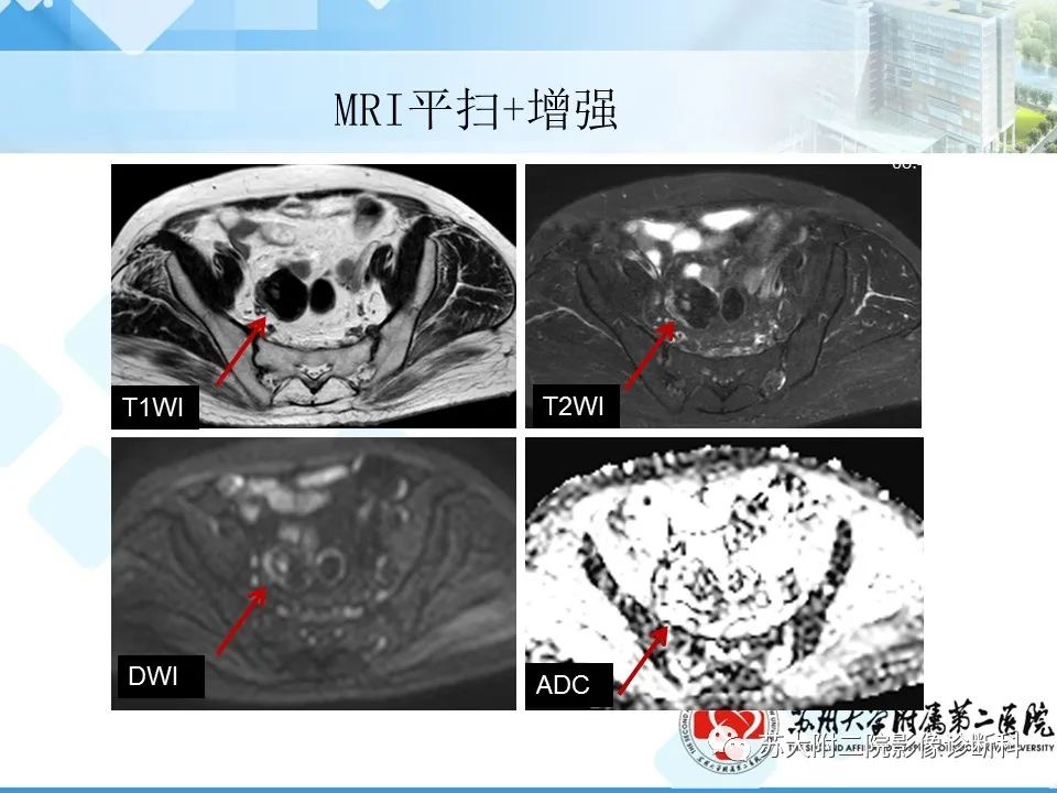 影像PPT - 【病例】卵巢Brenner瘤3例CT及MR影像-9