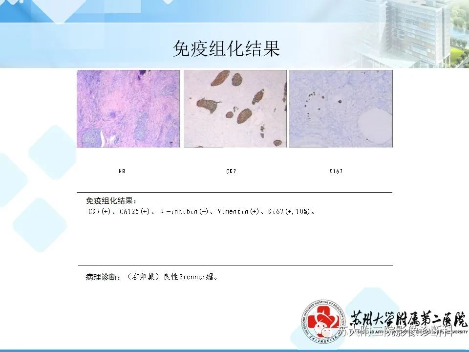 影像PPT - 【病例】卵巢Brenner瘤3例CT及MR影像-12