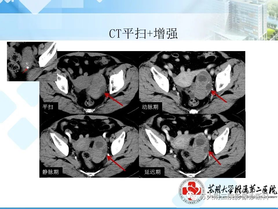 影像PPT - 【病例】卵巢Brenner瘤3例CT及MR影像-16