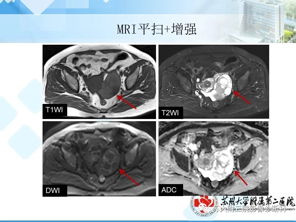 影像PPT - 【病例】卵巢Brenner瘤3例CT及MR影像-18