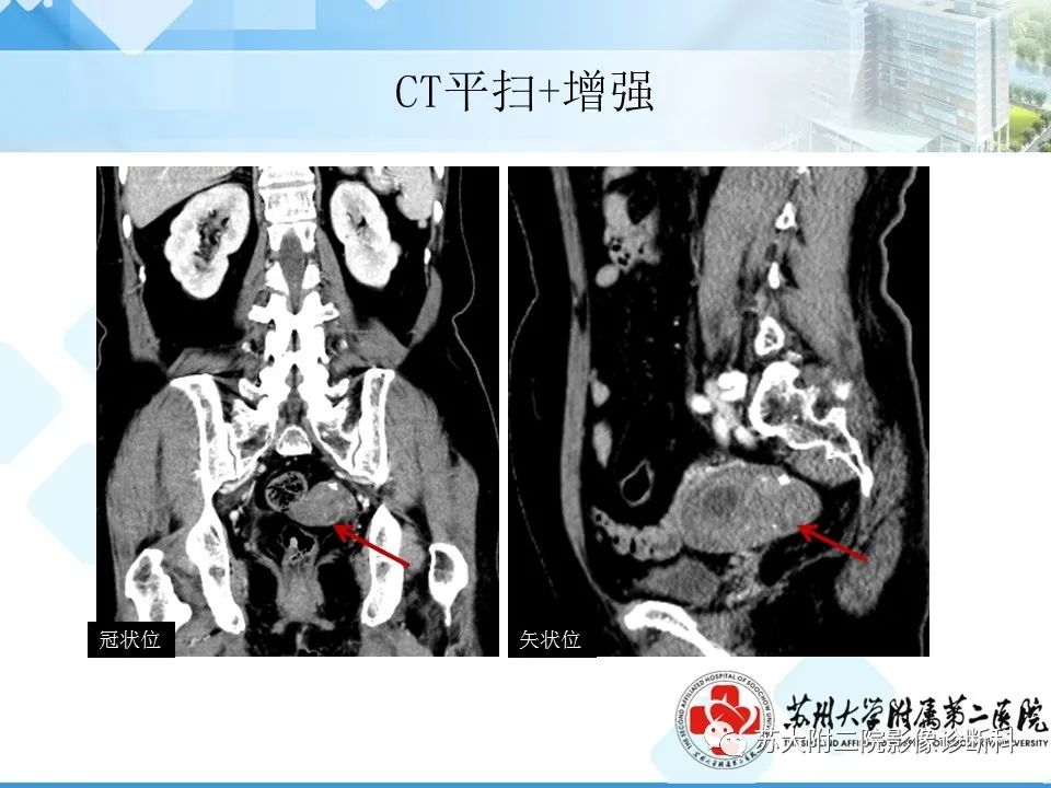 影像PPT - 【病例】卵巢Brenner瘤3例CT及MR影像-17