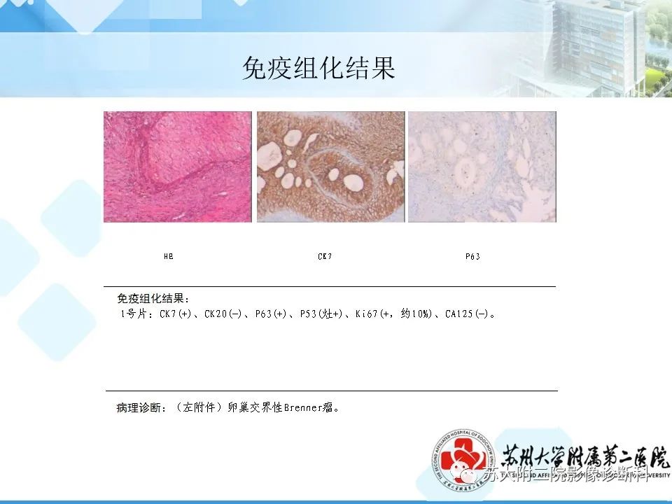 影像PPT - 【病例】卵巢Brenner瘤3例CT及MR影像-20