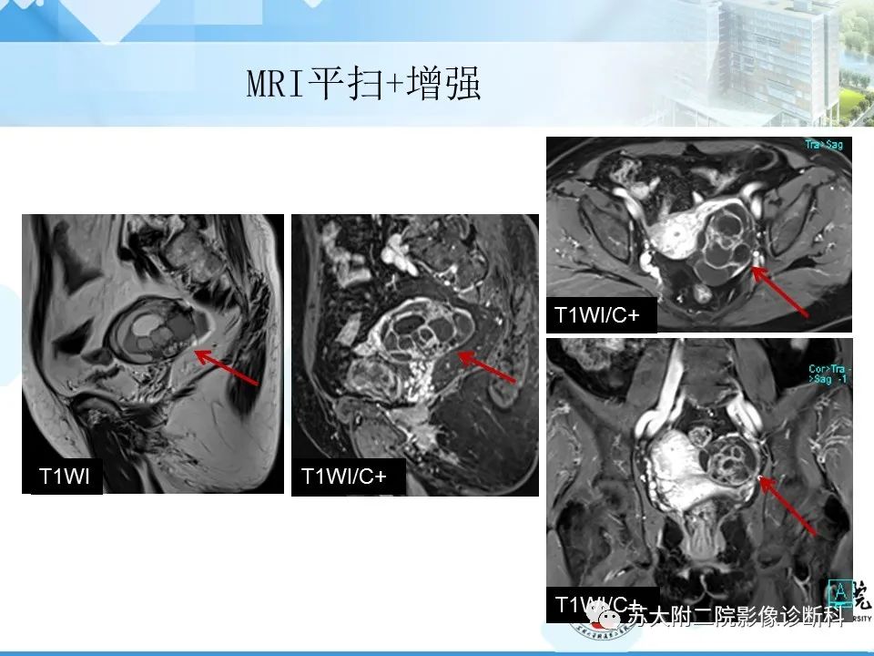 影像PPT - 【病例】卵巢Brenner瘤3例CT及MR影像-19