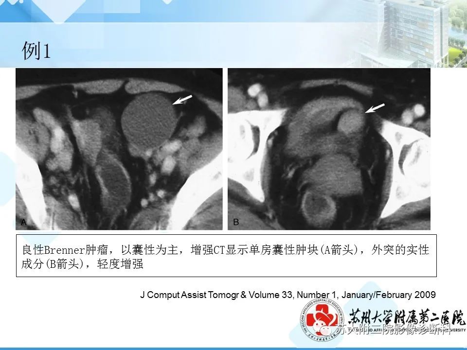 影像PPT - 【病例】卵巢Brenner瘤3例CT及MR影像-30